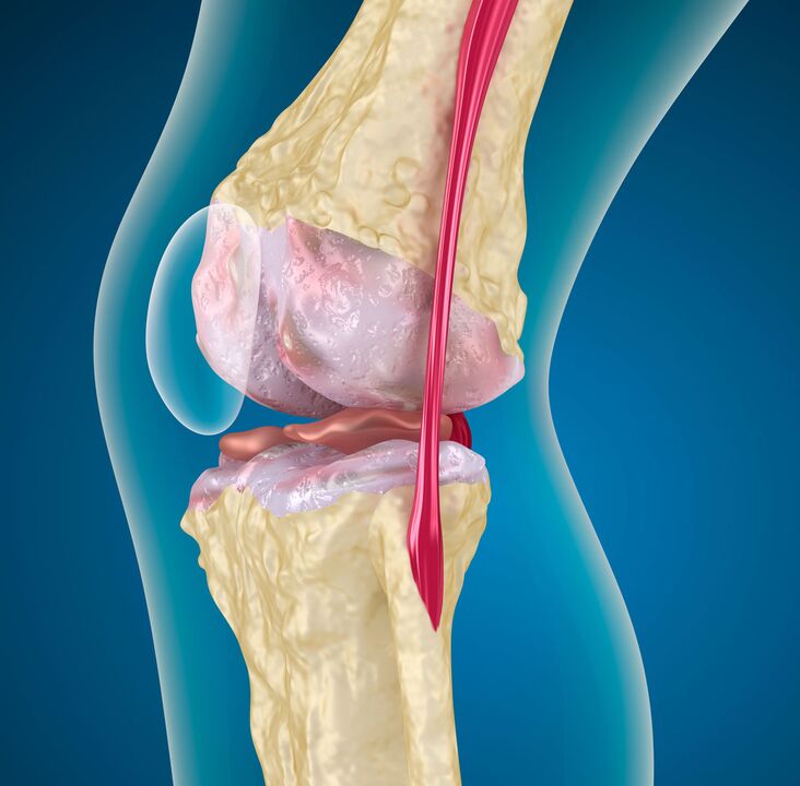 Arthrose