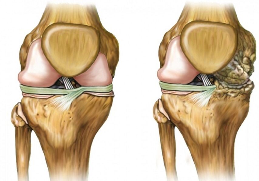 Deformierende Arthrose