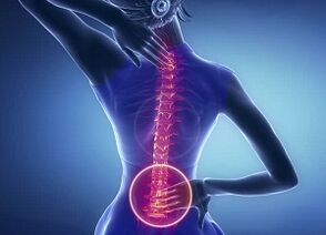 Manifestationen der lumbalen Osteochondrose